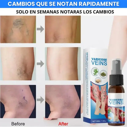 🩺 Varicose Veins™ Pro Tratamiento Intensivo Avanzado para Venas, Varices y Piernas Cansadas